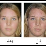 كيف تزيل حبوب البشرة من الصورة بدون برامج ؟